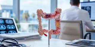 Most Young Colorectal Cancer Patients in New Study Were Diagnosed at Stage III or IV